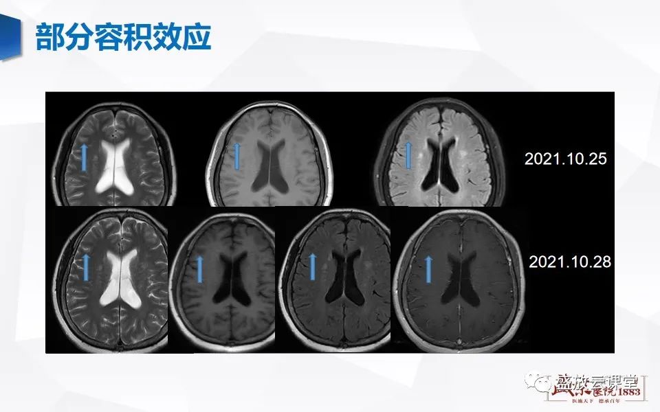 影像PPT - 【PPT】头部MR检查中常见的伪影-33