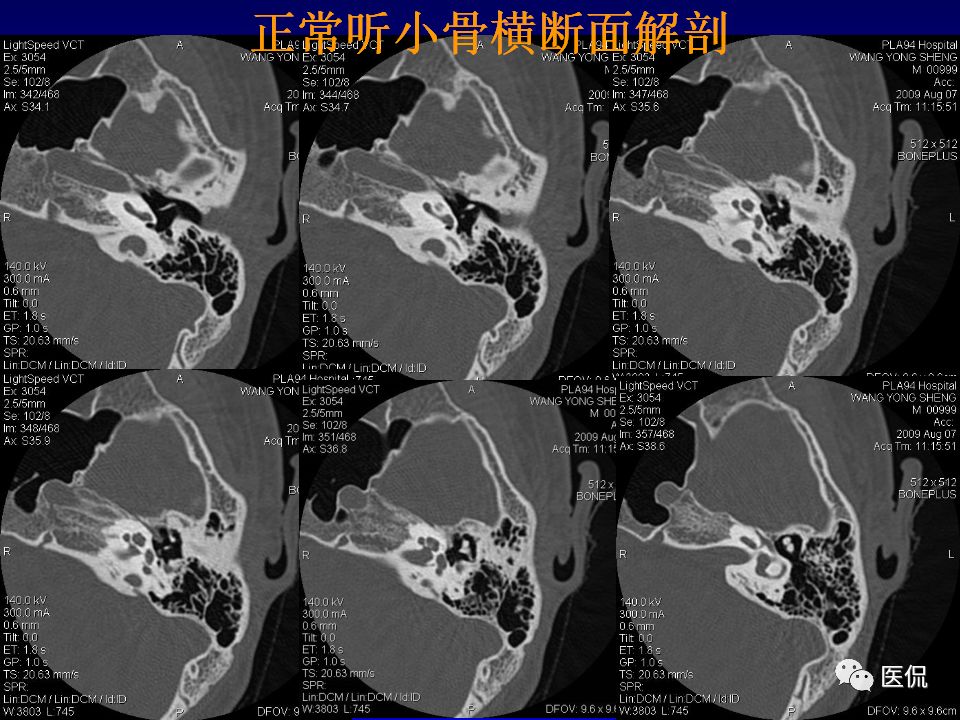 影像PPT - 【PPT】耳部影像诊断-32