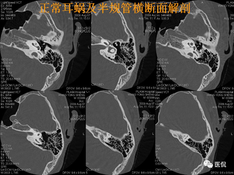 影像PPT - 【PPT】耳部影像诊断-33