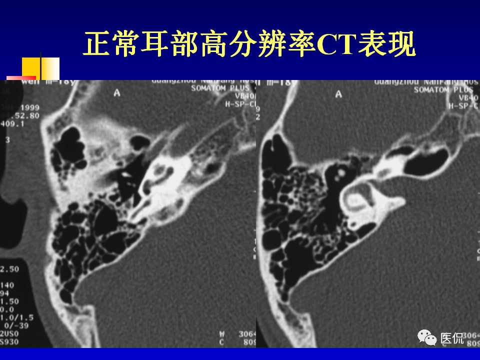 影像PPT - 【PPT】耳部影像诊断-43