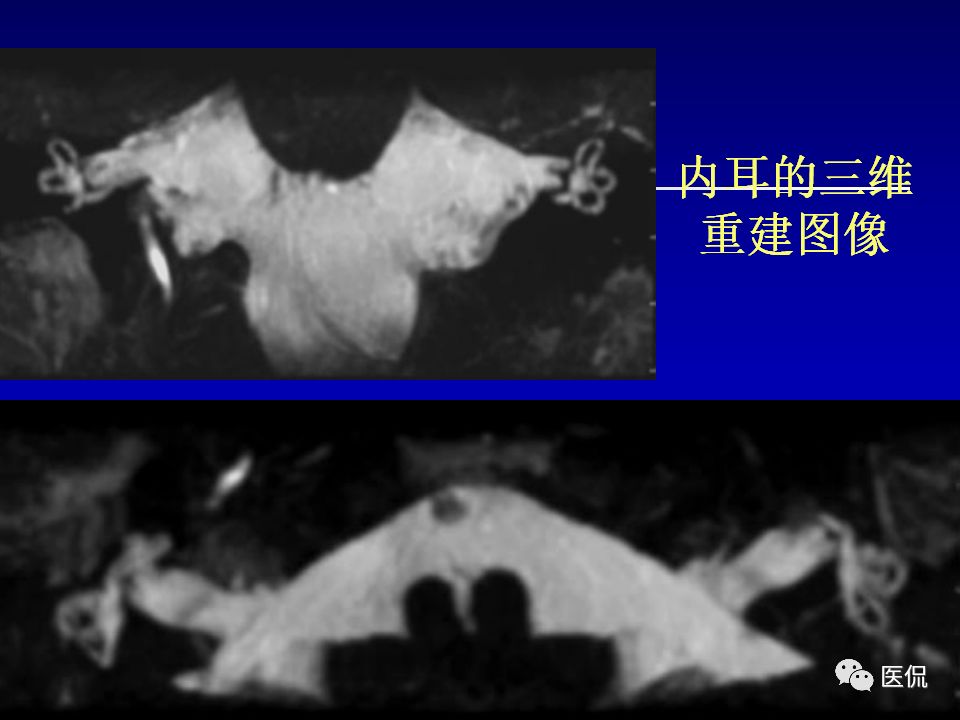 影像PPT - 【PPT】耳部影像诊断-44
