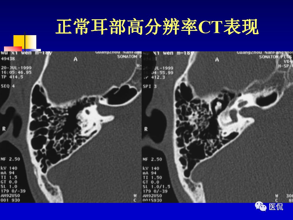 影像PPT - 【PPT】耳部影像诊断-42
