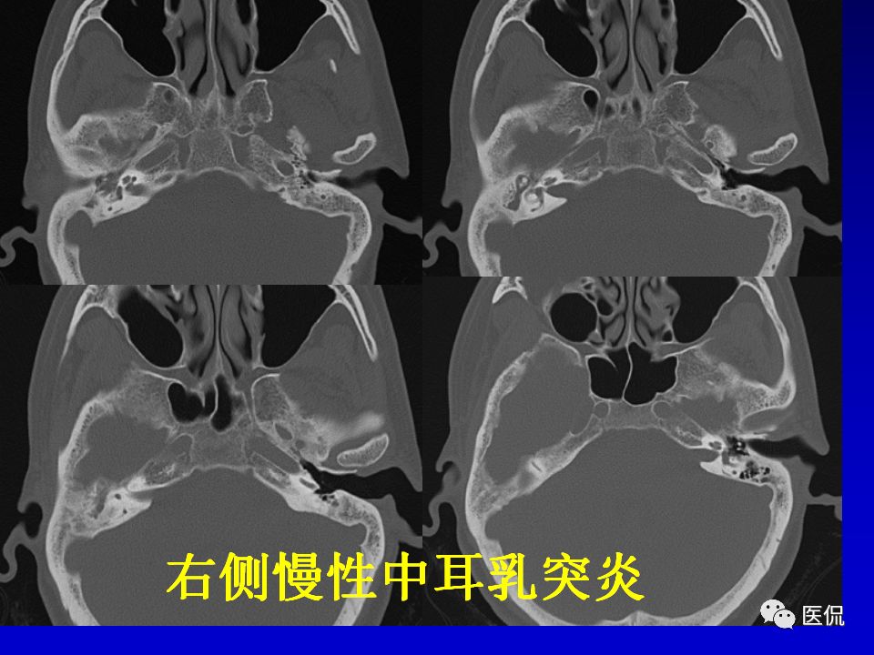 影像PPT - 【PPT】耳部影像诊断-51