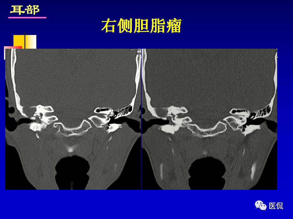 影像PPT - 【PPT】耳部影像诊断-56