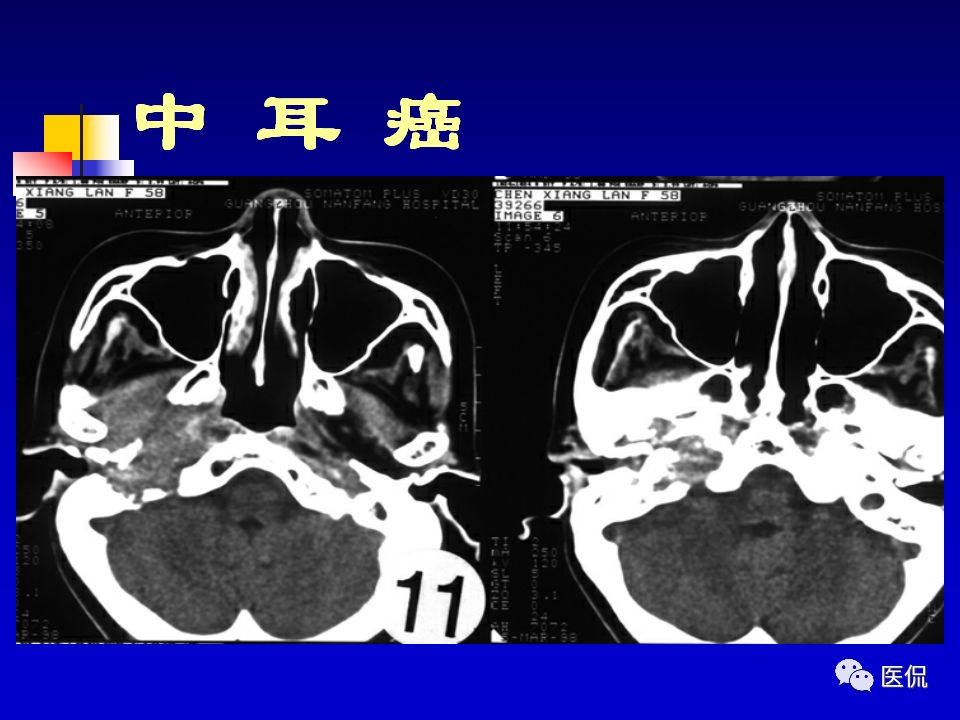 影像PPT - 【PPT】耳部影像诊断-60