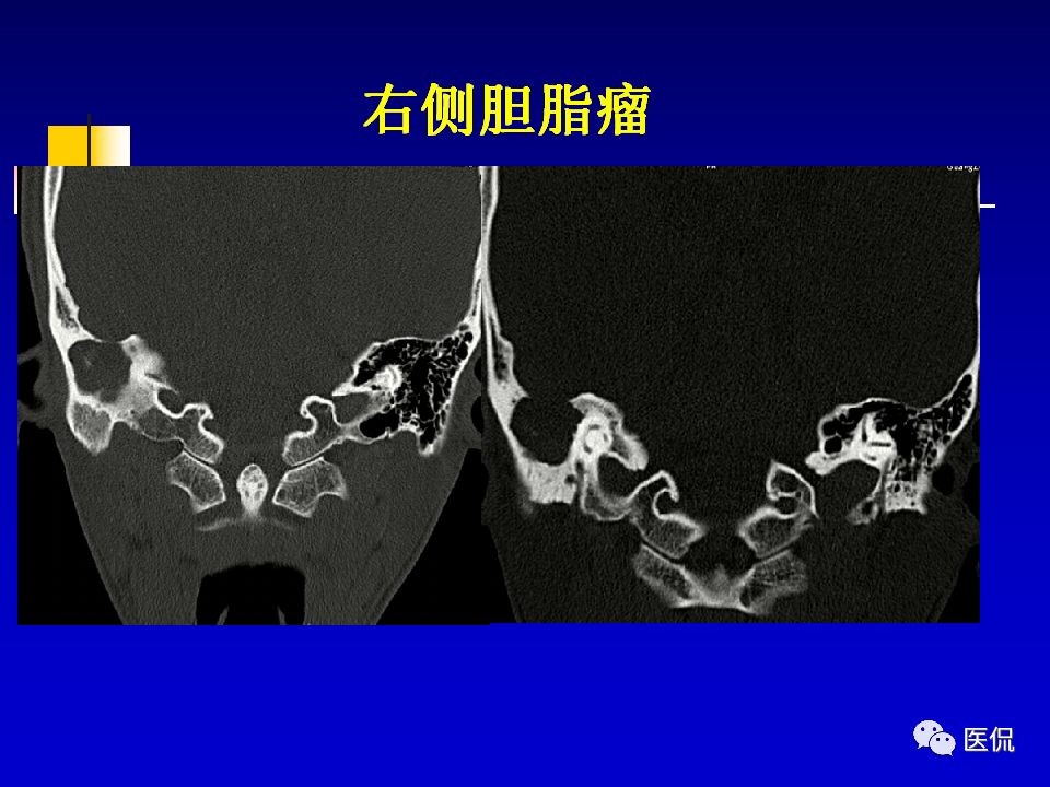 影像PPT - 【PPT】耳部影像诊断-57