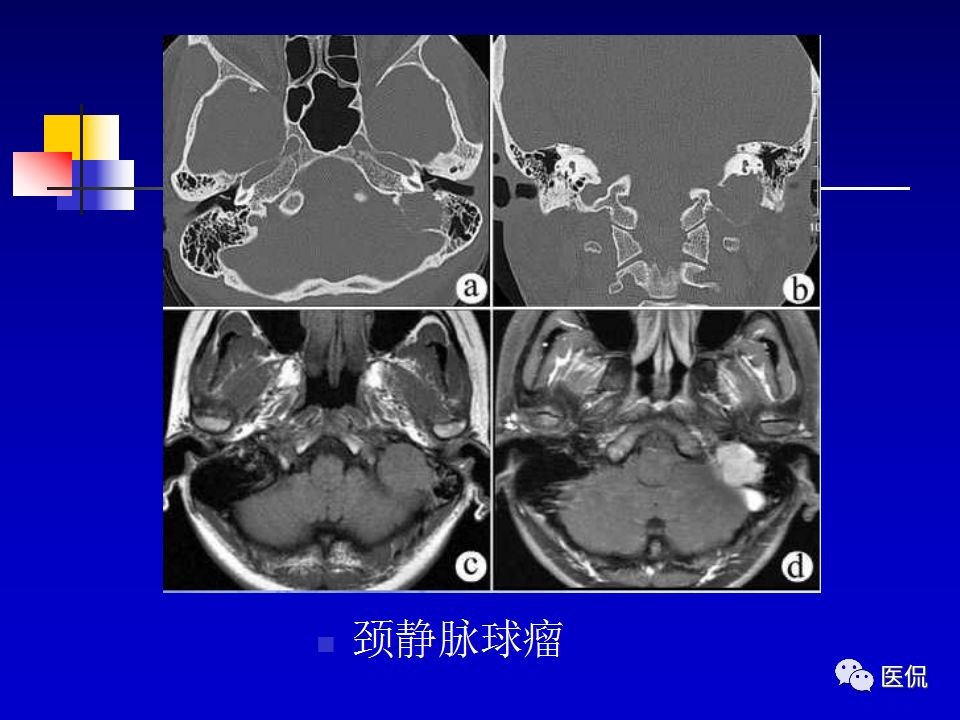 影像PPT - 【PPT】耳部影像诊断-62