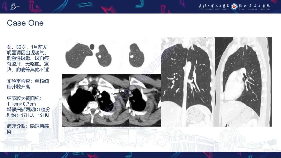 影像PPT - 【PPT】活动性肺结核不典型CT表现-2