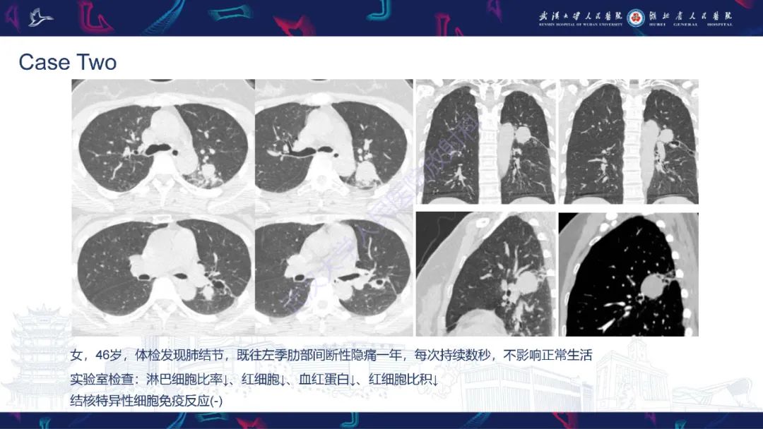 影像PPT - 【PPT】活动性肺结核不典型CT表现-3