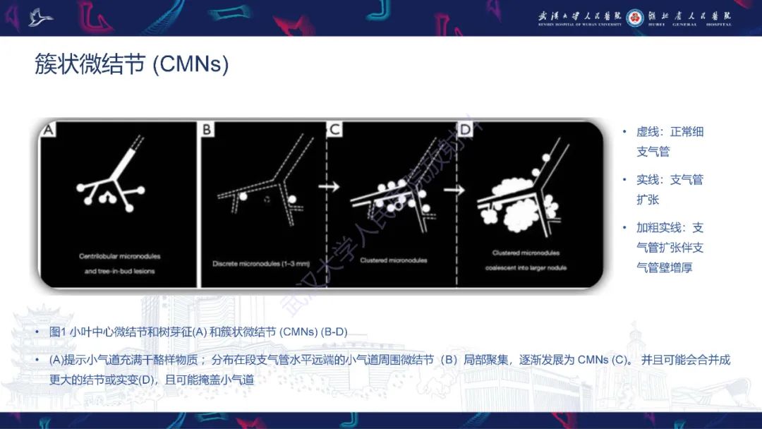 影像PPT - 【PPT】活动性肺结核不典型CT表现-9