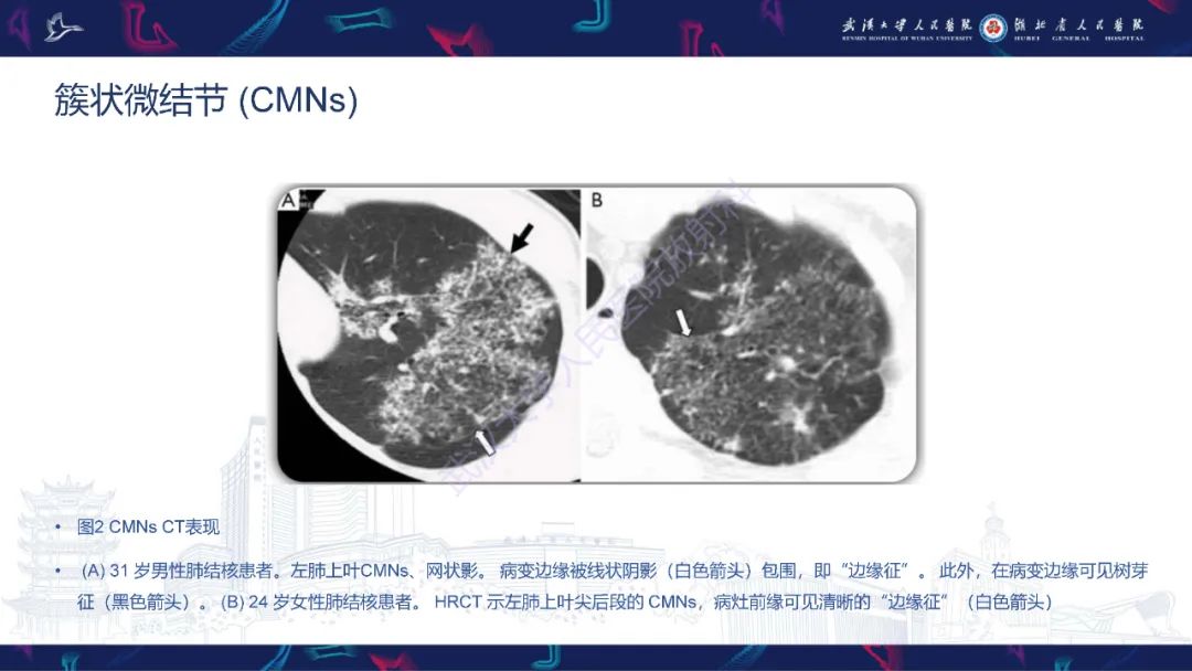 影像PPT - 【PPT】活动性肺结核不典型CT表现-11