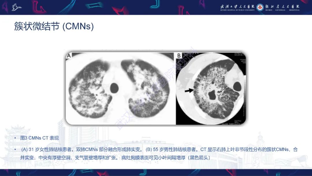 影像PPT - 【PPT】活动性肺结核不典型CT表现-12