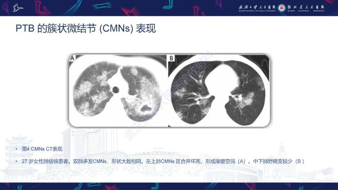 影像PPT - 【PPT】活动性肺结核不典型CT表现-13