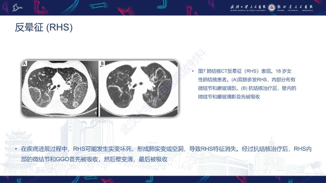 影像PPT - 【PPT】活动性肺结核不典型CT表现-16