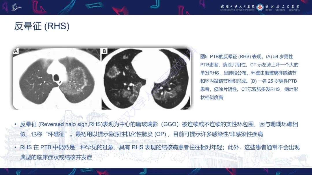 影像PPT - 【PPT】活动性肺结核不典型CT表现-14