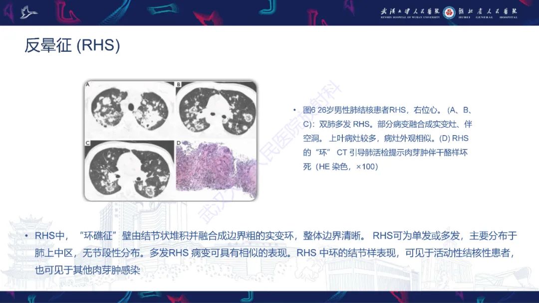 影像PPT - 【PPT】活动性肺结核不典型CT表现-15