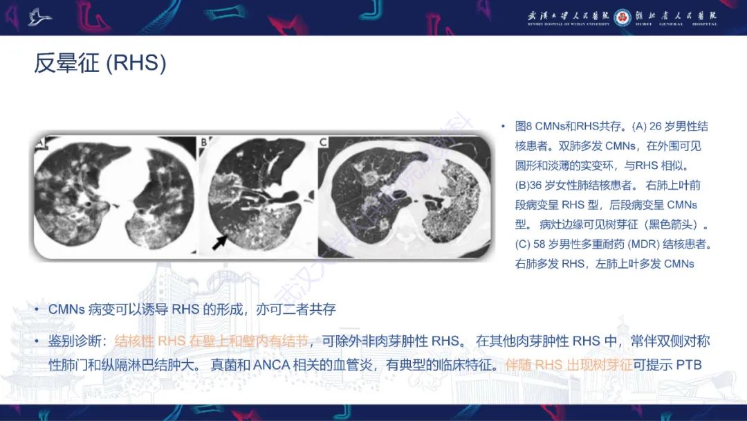 影像PPT - 【PPT】活动性肺结核不典型CT表现-17