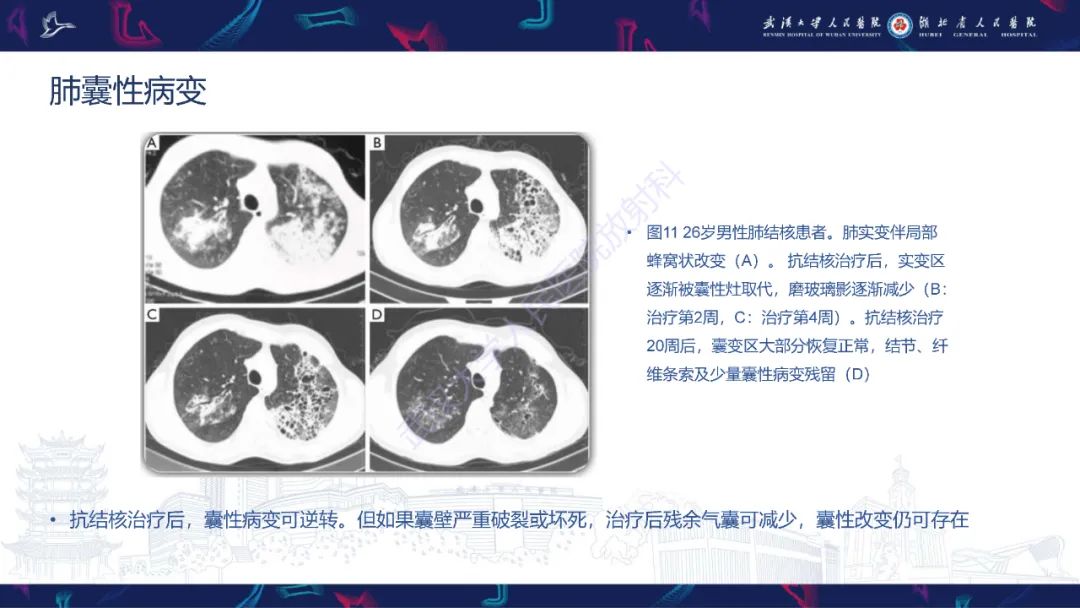 影像PPT - 【PPT】活动性肺结核不典型CT表现-20
