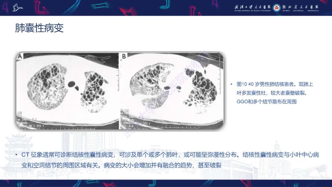 影像PPT - 【PPT】活动性肺结核不典型CT表现-19