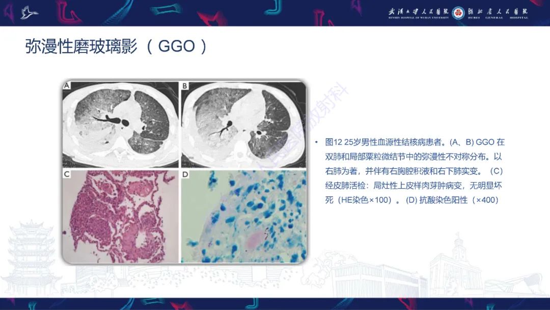 影像PPT - 【PPT】活动性肺结核不典型CT表现-22