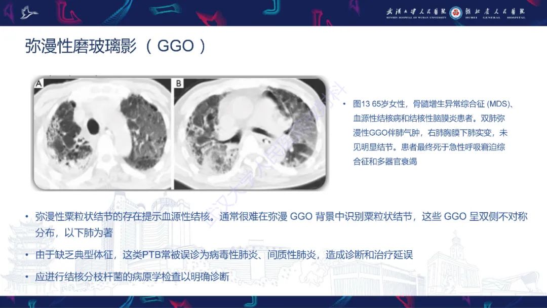影像PPT - 【PPT】活动性肺结核不典型CT表现-23