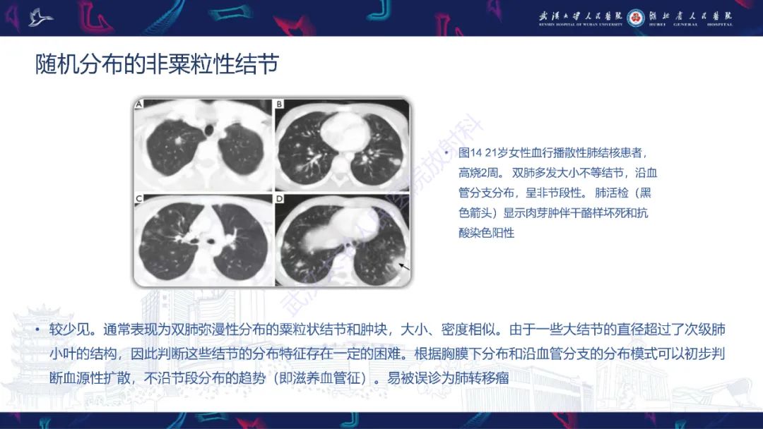 影像PPT - 【PPT】活动性肺结核不典型CT表现-24