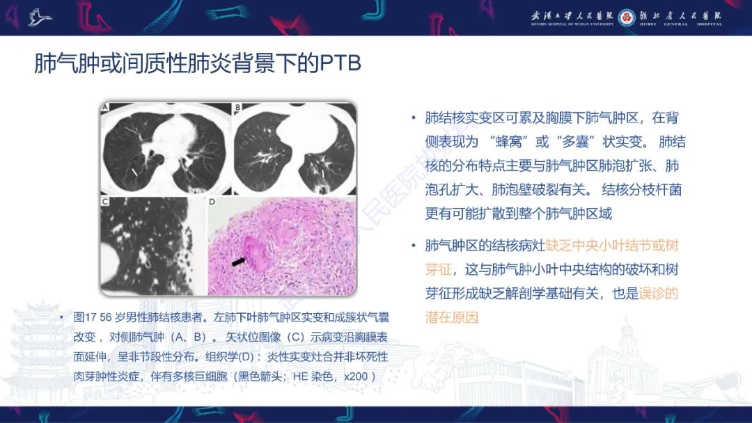 影像PPT - 【PPT】活动性肺结核不典型CT表现-28
