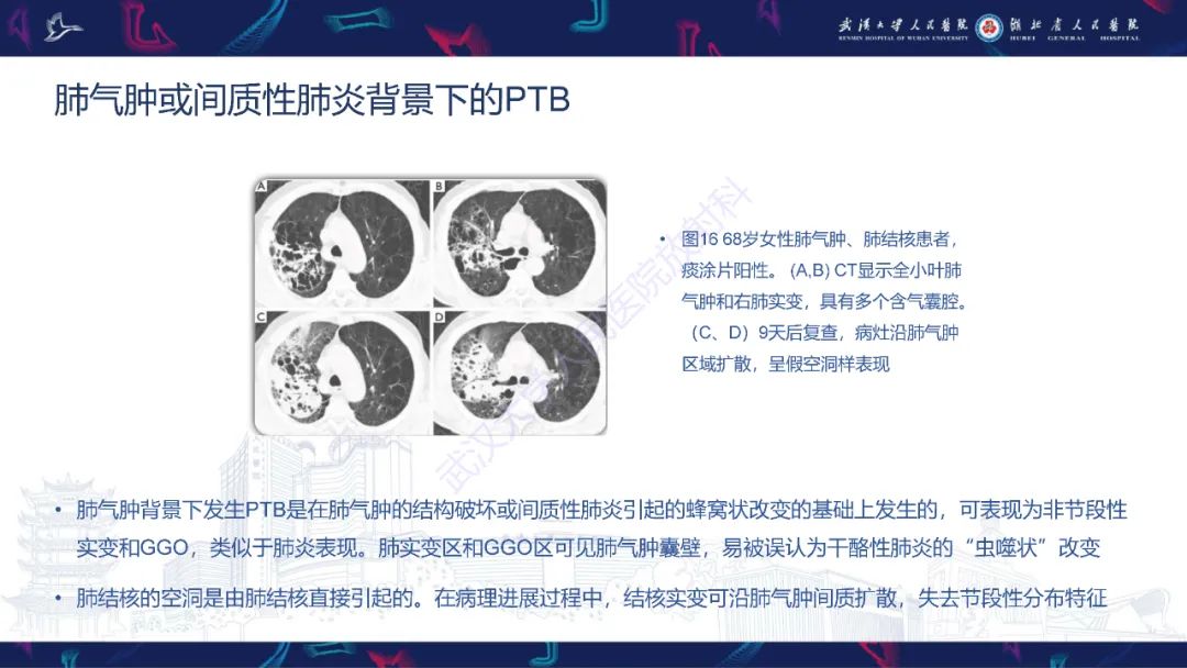 影像PPT - 【PPT】活动性肺结核不典型CT表现-27