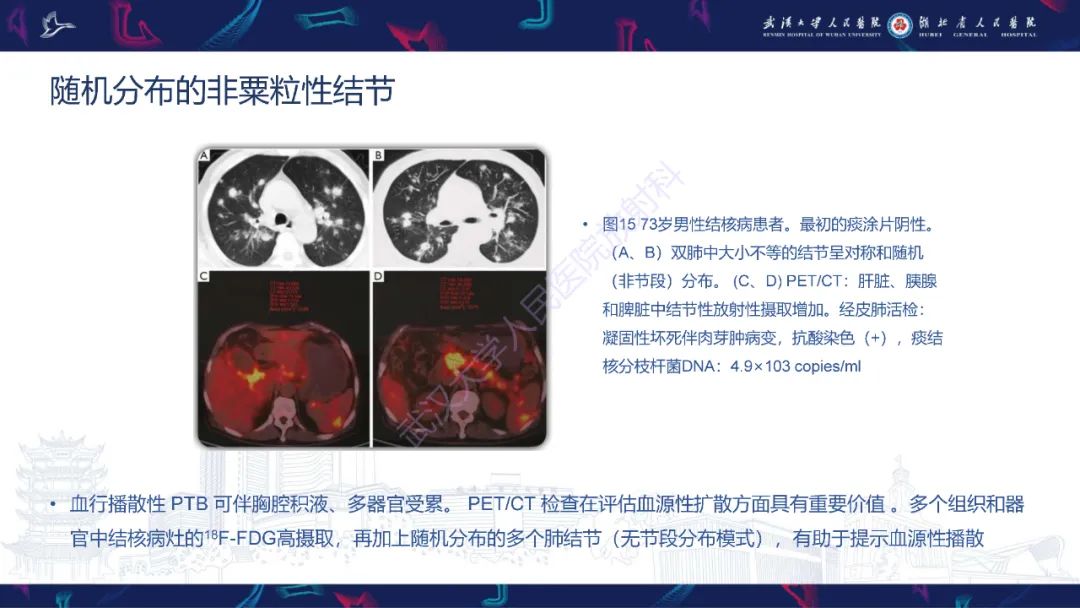 影像PPT - 【PPT】活动性肺结核不典型CT表现-25