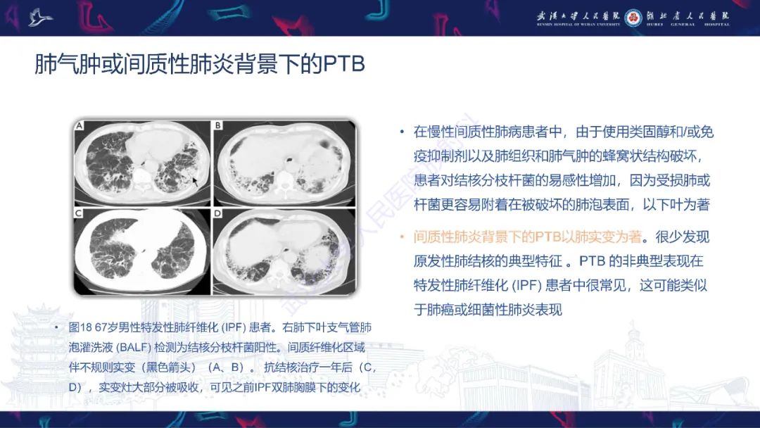 影像PPT - 【PPT】活动性肺结核不典型CT表现-29