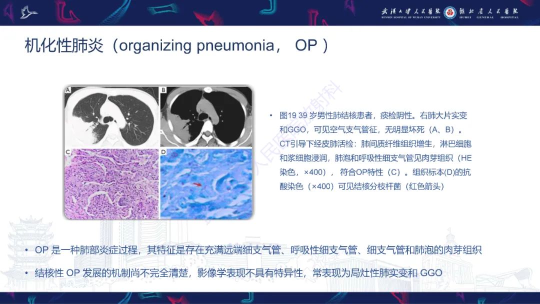 影像PPT - 【PPT】活动性肺结核不典型CT表现-30