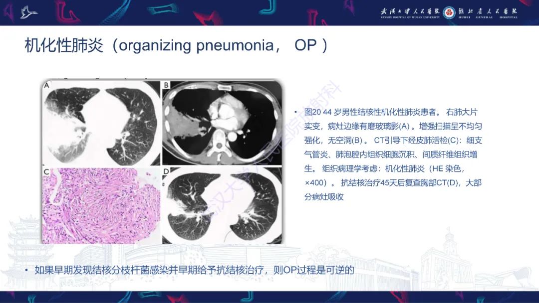 影像PPT - 【PPT】活动性肺结核不典型CT表现-31