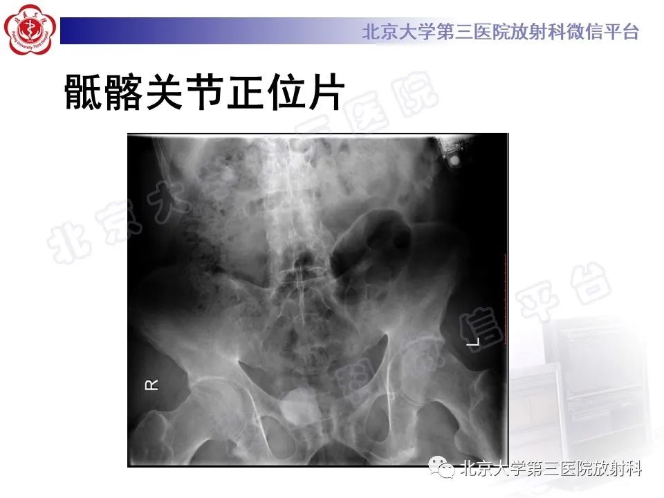 影像PPT - 【PPT】强直性脊柱炎合并ANDERSSON损害-3