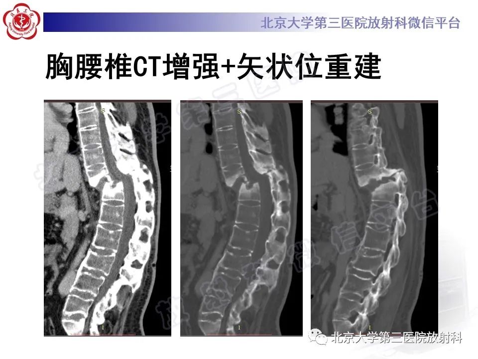 影像PPT - 【PPT】强直性脊柱炎合并ANDERSSON损害-4