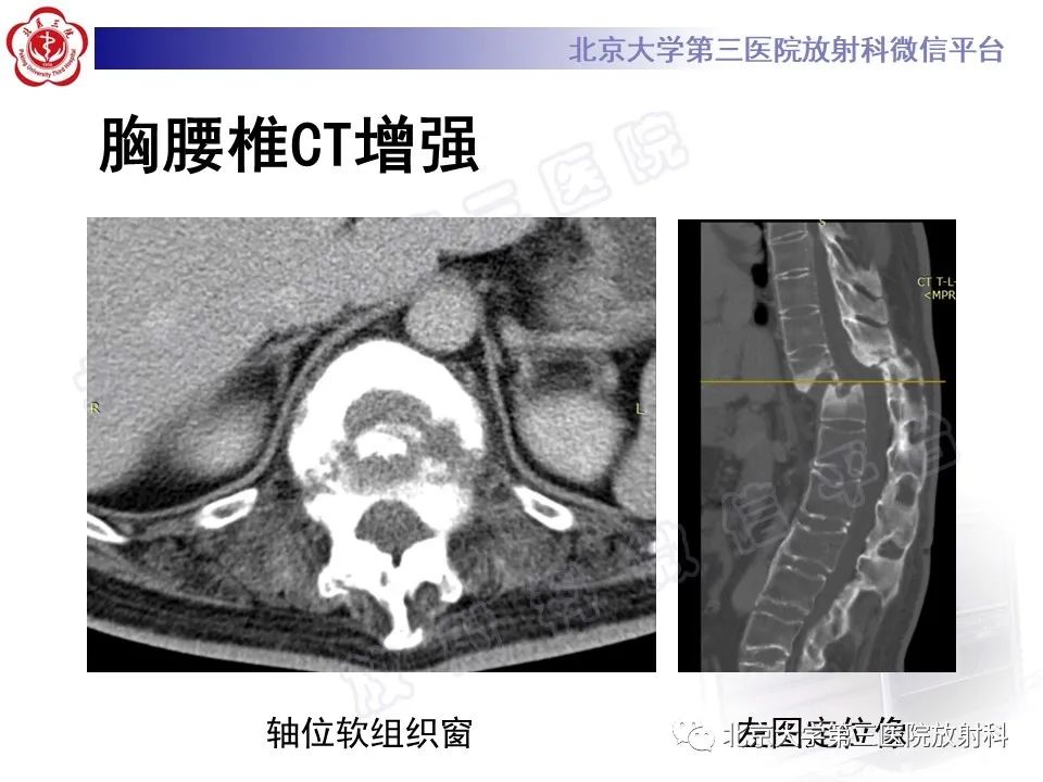 影像PPT - 【PPT】强直性脊柱炎合并ANDERSSON损害-5