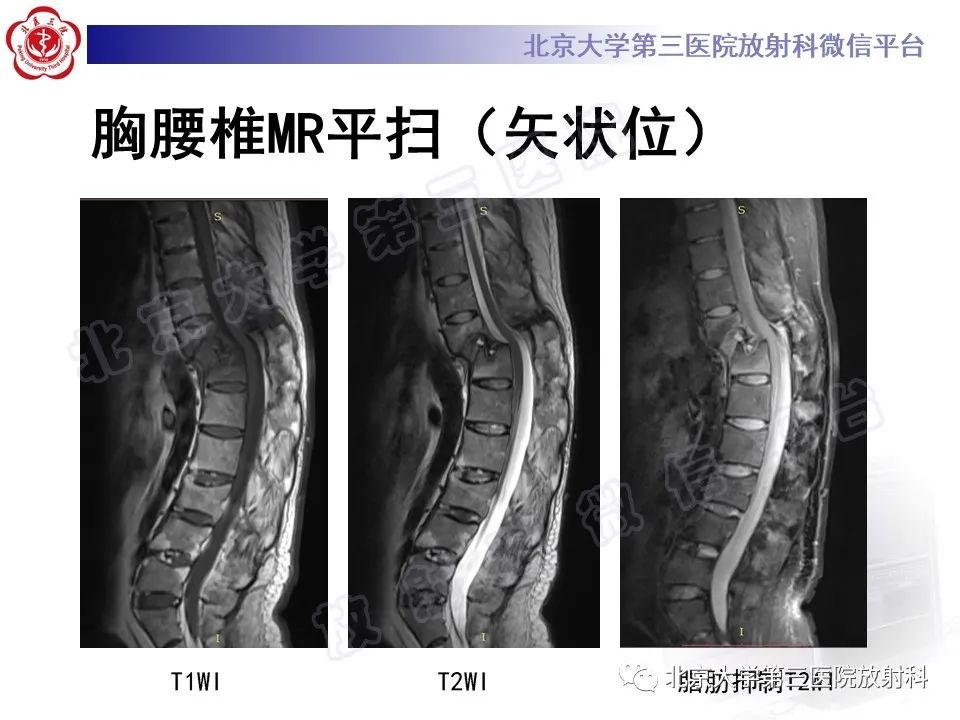 影像PPT - 【PPT】强直性脊柱炎合并ANDERSSON损害-6
