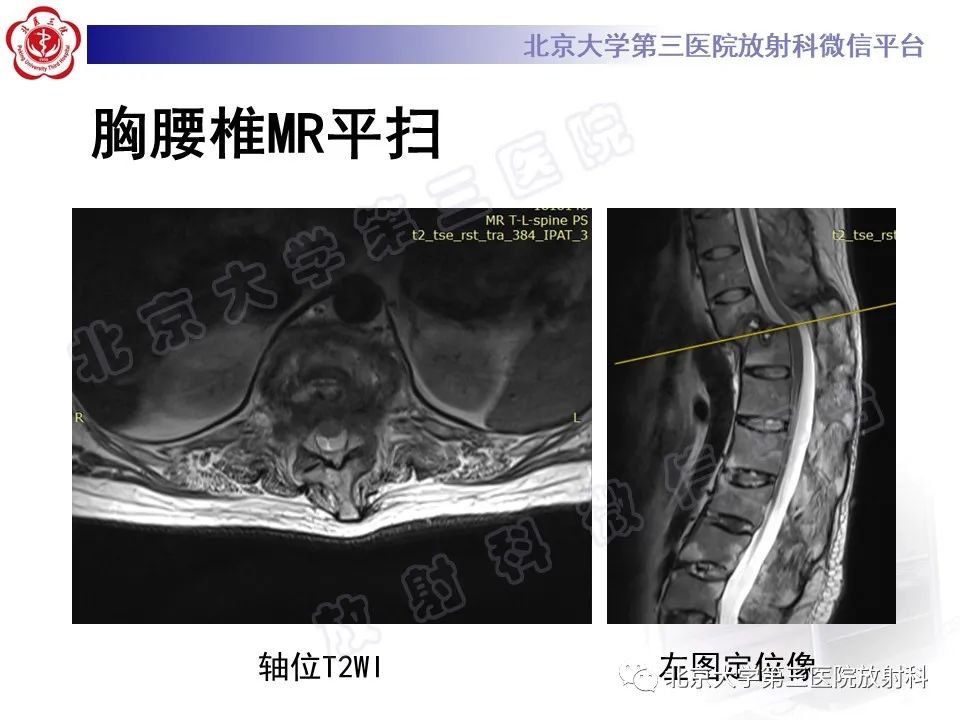 影像PPT - 【PPT】强直性脊柱炎合并ANDERSSON损害-8