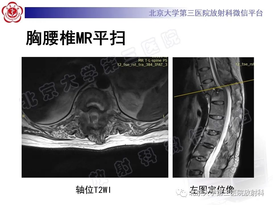 影像PPT - 【PPT】强直性脊柱炎合并ANDERSSON损害-7