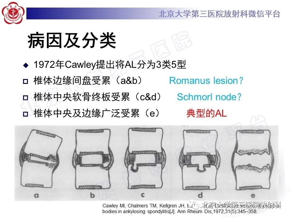 影像PPT - 【PPT】强直性脊柱炎合并ANDERSSON损害-13