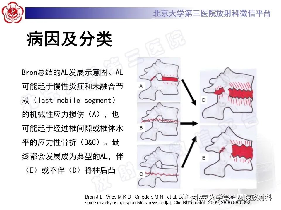影像PPT - 【PPT】强直性脊柱炎合并ANDERSSON损害-15