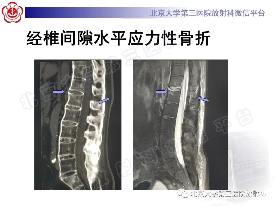 影像PPT - 【PPT】强直性脊柱炎合并ANDERSSON损害-16