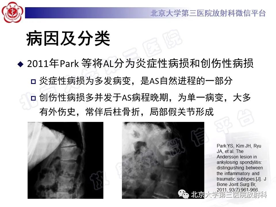 影像PPT - 【PPT】强直性脊柱炎合并ANDERSSON损害-17