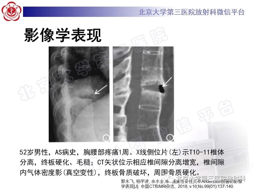 影像PPT - 【PPT】强直性脊柱炎合并ANDERSSON损害-20