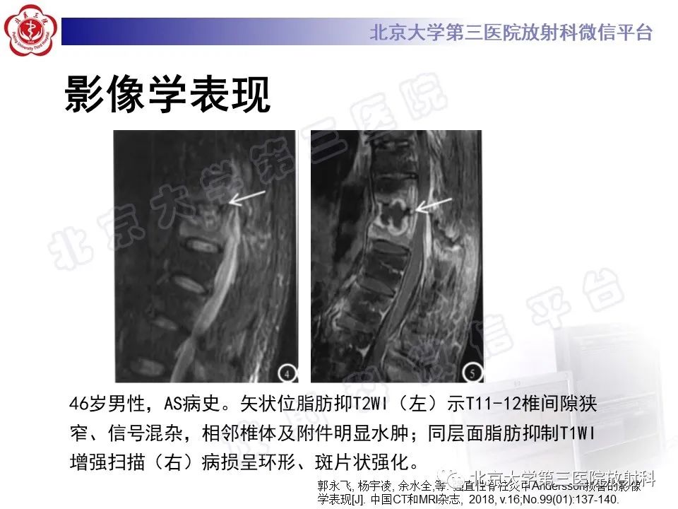 影像PPT - 【PPT】强直性脊柱炎合并ANDERSSON损害-23