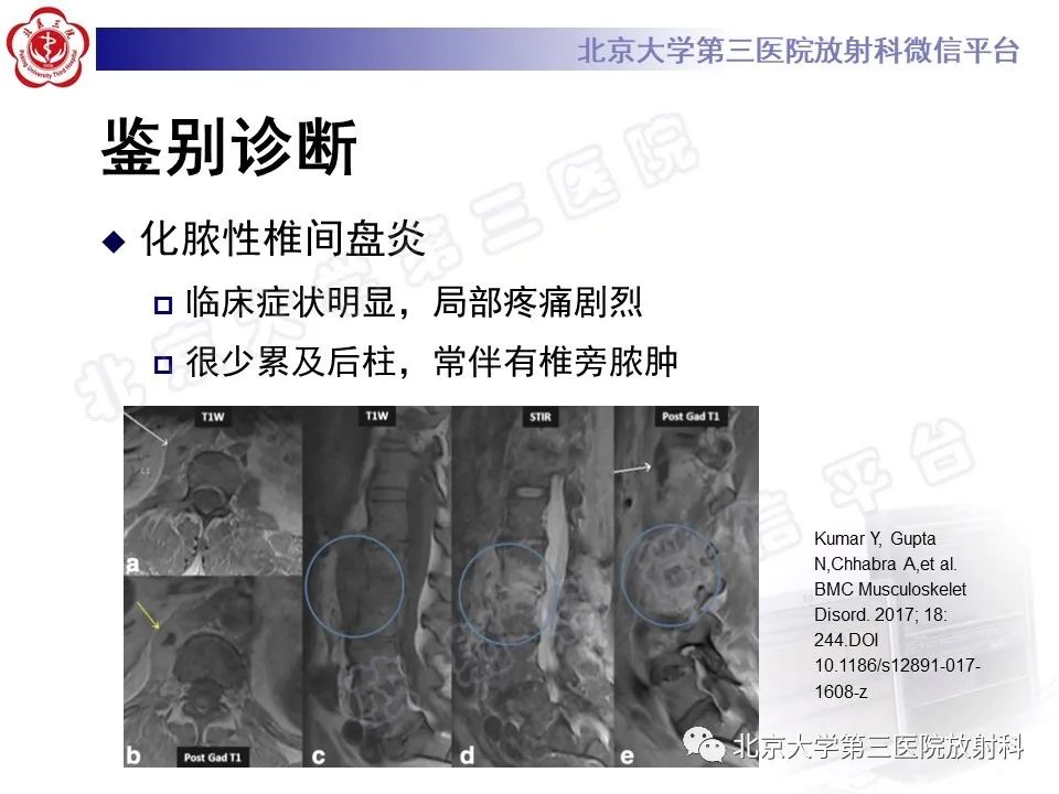 影像PPT - 【PPT】强直性脊柱炎合并ANDERSSON损害-25