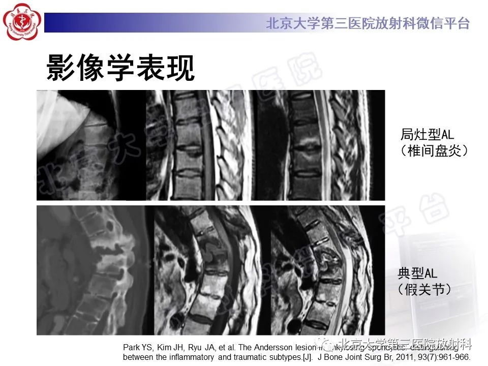 影像PPT - 【PPT】强直性脊柱炎合并ANDERSSON损害-22