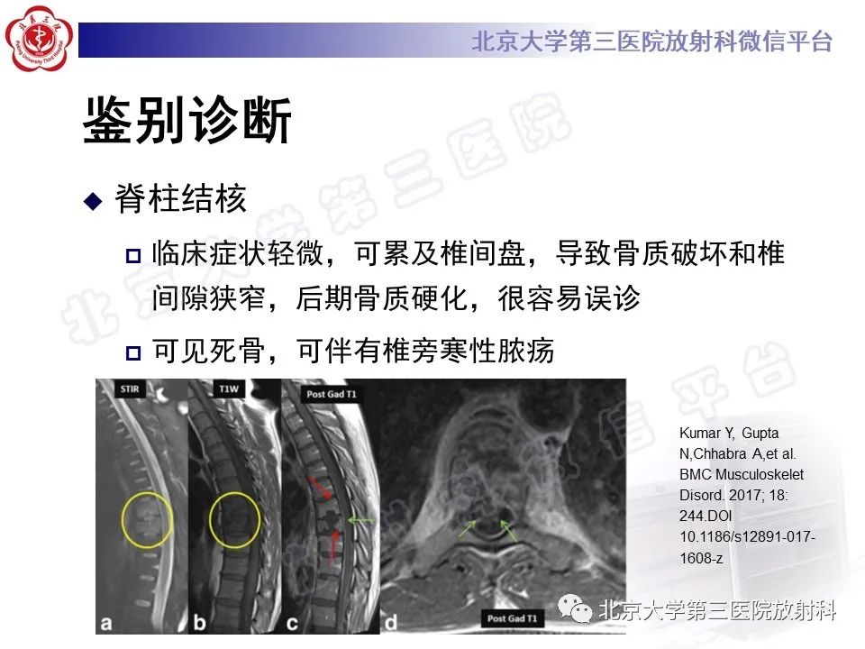 影像PPT - 【PPT】强直性脊柱炎合并ANDERSSON损害-26