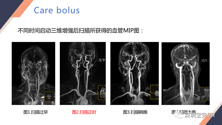 影像PPT - 【PPT】头颈CE-MRA扫描技术-4