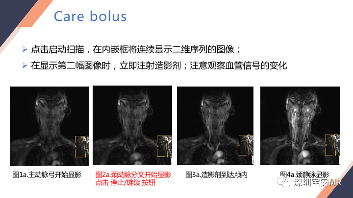 影像PPT - 【PPT】头颈CE-MRA扫描技术-8
