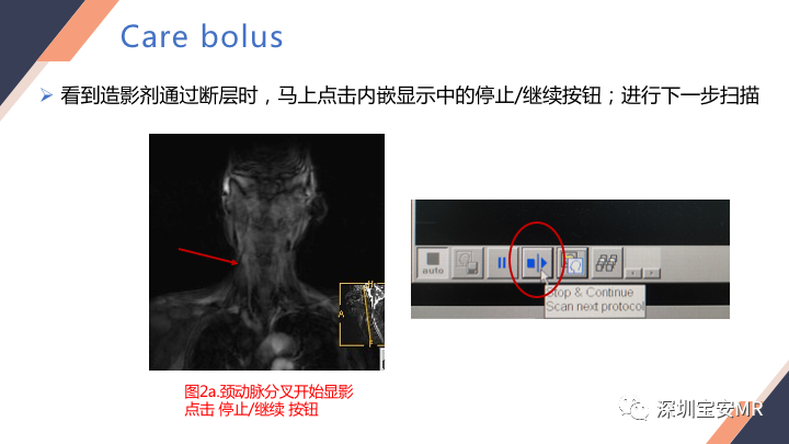 影像PPT - 【PPT】头颈CE-MRA扫描技术-9